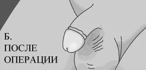 Обрезание по типу розочки фото — изображение 16