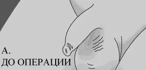 Обрезание по типу розочки фото — изображение 15